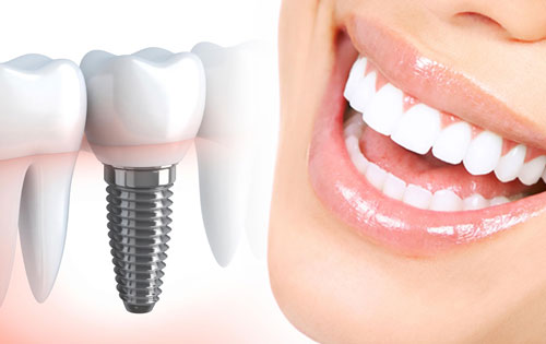 همه چیزهایی که باید درباره ایمپلنت دندان بدانید