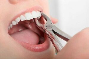 چه بلایی بر سر جای خالی دندان ها می آید؟
