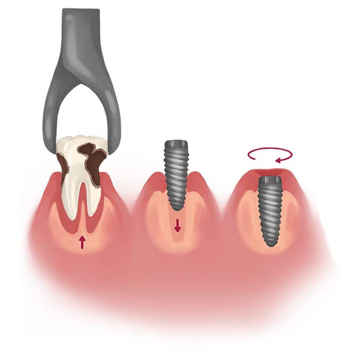 کشیدن دندان و ایمپلنت فوری دندان