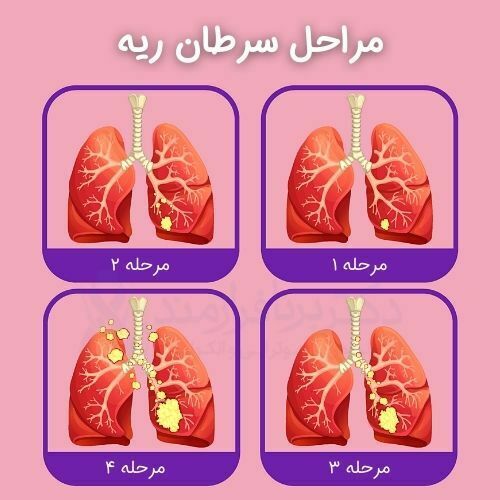 سرطان ریه چیست؟ علائمی که باید بدانید